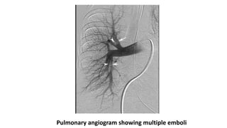 Pulmonary angiogram showing multiple emboli
 