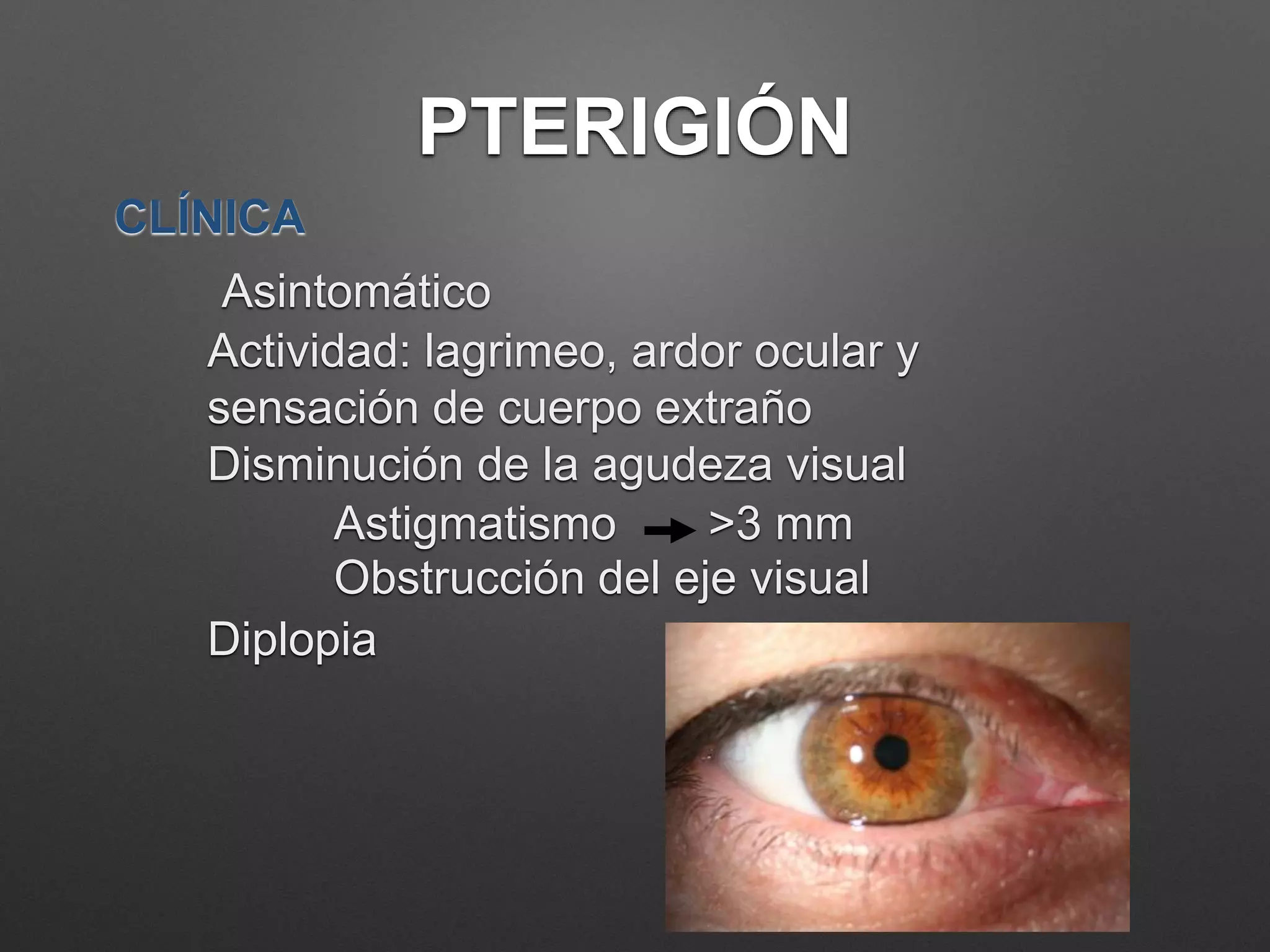 Piterigeno Pterigion | PPTX