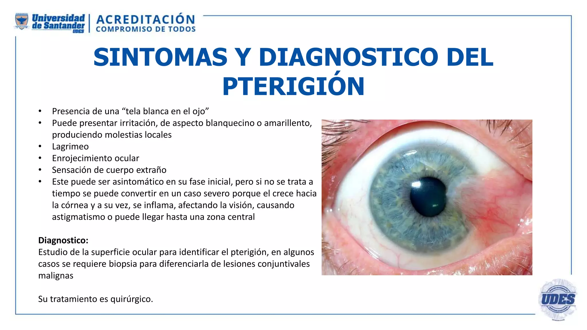 Piterigeno PTERIGION ANATOMIA, TECNICA QX.pptx