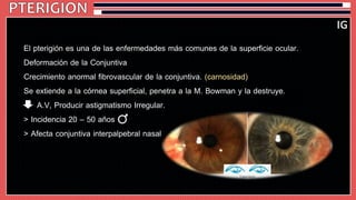 El pterigión es una de las enfermedades más comunes de la superficie ocular. 
Deformación de la Conjuntiva 
Crecimiento anormal fibrovascular de la conjuntiva. (carnosidad) 
Se extiende a la córnea superficial, penetra a la M. Bowman y la destruye. 
A.V, Producir astigmatismo Irregular. 
> Incidencia 20 – 50 años 
> Afecta conjuntiva interpalpebral nasal 
 