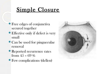 Pterygium | PPT