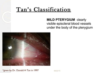 Pterygium | PPT