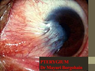 PTERYGIUM
Dr Mayuri Borgohain
 