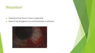 Procedure
 Subconjunctival Tenon’s tissue is separated
 Head of the pterygium is cut and hemostatis is achieved
 