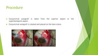 Procedure
 Conjunctival autograft is taken from the superior aspect or the
superotemporal aspect
 Conjunctival autograft is rotated and placed on the bare sclera
 