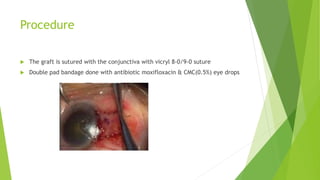 Procedure
 The graft is sutured with the conjunctiva with vicryl 8-0/9-0 suture
 Double pad bandage done with antibiotic moxifloxacin & CMC(0.5%) eye drops
 