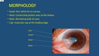 PTERYGIUM. PATHOPHYSIOLOGY . CLINICAL FEATURES . SURGICAL MANAGEMENT | PPTX