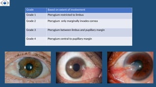 PTERYGIUM. PATHOPHYSIOLOGY . CLINICAL FEATURES . SURGICAL MANAGEMENT | PPTX