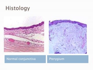 Normal conjunctiva Pterygium
 