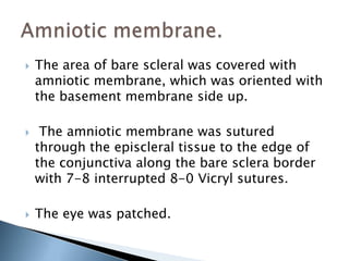  The area of bare scleral was covered with
amniotic membrane, which was oriented with
the basement membrane side up.
 The amniotic membrane was sutured
through the episcleral tissue to the edge of
the conjunctiva along the bare sclera border
with 7-8 interrupted 8-0 Vicryl sutures.
 The eye was patched.
 