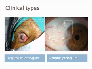Progressive pterygium   Atrophic pterygium
 