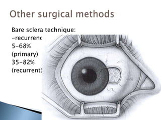 Bare sclera technique:
-recurrence:
5-68%
(primary)
35-82%
(recurrent)
 