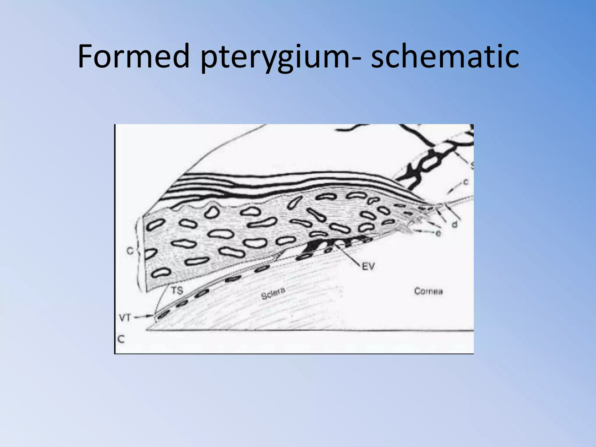 Pterygium and its management | PPTX