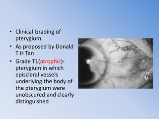 Pterygium and its management | PPTX
