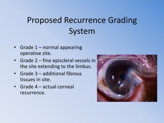 Pterygium and its management | PPTX