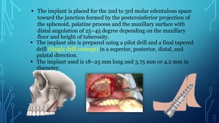  The implant is placed for the 2nd to 3rd molar edentulous space
toward the junction formed by the posteroinferior projection of
the sphenoid, palatine process and the maxillary surface with
distal angulation of 25–45 degree depending on the maxillary
floor and height of tuberosity.
 The implant site is prepared using a pilot drill and a final tapered
drill (Single drill concept) in a superior, posterior, distal, and
palatal direction.
 The implant used is 18–25 mm long and 3.75 mm or 4.2 mm in
diameter.
 