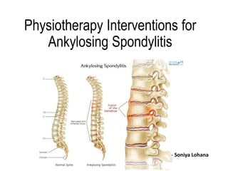 Physiotherapy Interventions for
Ankylosing Spondylitis
- Soniya Lohana
 