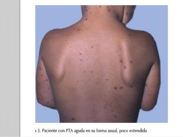 Autoinmune Autoinmune