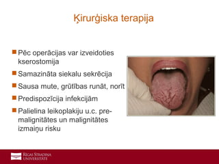20
 Pēc operācijas var izveidoties
kserostomija
 Samazināta siekalu sekrēcija
 Sausa mute, grūtības runāt, norīt
 Predispozīcija infekcijām
 Palielina leikoplakiju u.c. pre-
malignitātes un malignitātes
izmaiņu risku
Ķirurģiska terapija
 