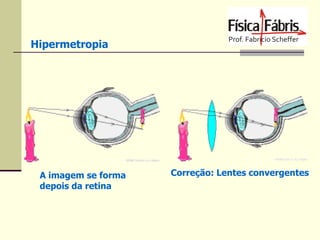 Hipermetropia

A imagem se forma
depois da retina

Correção: Lentes convergentes

 