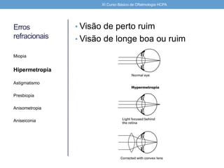 Erros
refracionais
• Visão de perto ruim
• Visão de longe boa ou ruim
Miopia
Hipermetropia
Astigmatismo
Presbiopia
Anisometropia
Aniseiconia
XI Curso Básico de Oftalmologia HCPA
 