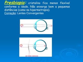 Presbiopia :   cristalino fica menos flexível conforme a idade. Não enxerga bem a pequenas distâncias (como na hipermetropia). Correção : Lentes Convergentes 