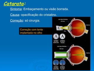 Catarata : Sintoma : Embaçamento ou visão borrada. Causa : opacificação do cristalino. Correção : só cirurgia. Correção com lente implantada no olho 