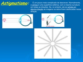 Astigmatismo :   É um pouco mais complicado de descrever. Normalmente, a  córnea  é uma superfície esférica, com a mesma curvatura em todas as direções. Se, no entanto, ela se  achata em alguma direção  as imagens na retina ficam desfocadas nessa direção.  