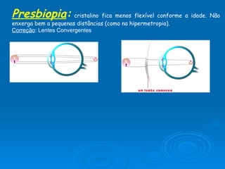 Presbiopia :   cristalino fica menos flexível conforme a idade. Não enxerga bem a pequenas distâncias (como na hipermetropia). Correção : Lentes Convergentes 