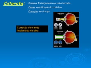 Catarata : Sintoma : Embaçamento ou visão borrada. Causa : opacificação do cristalino. Correção : só cirurgia. Correção com lente implantada no olho 