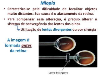 Miopia
• Caracteriza-se pela dificuldade de focalizar objetos
muito distantes. Sua causa é o afastamento da retina.
• Para compensar essa alteração, é preciso alterar o
sistema de convergência das lentes dos olhos
Utilização de lentes divergentes ou por cirurgia
A imagem é
formada antes
da retina
 