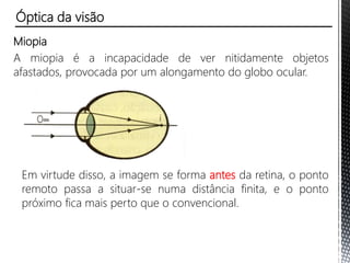 Miopia
A miopia é a incapacidade de ver nitidamente objetos
afastados, provocada por um alongamento do globo ocular.
Em virtude disso, a imagem se forma antes da retina, o ponto
remoto passa a situar-se numa distância finita, e o ponto
remoto fica mais perto que o convencional.
Óptica da visão
 
