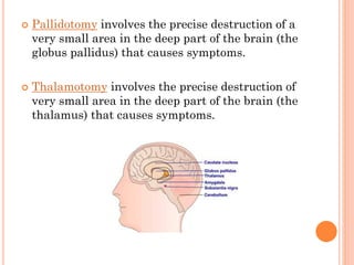



Pallidotomy involves the precise destruction of a
very small area in the deep part of the brain (the
globus pallidus) that causes symptoms.
Thalamotomy involves the precise destruction of
very small area in the deep part of the brain (the
thalamus) that causes symptoms.

 