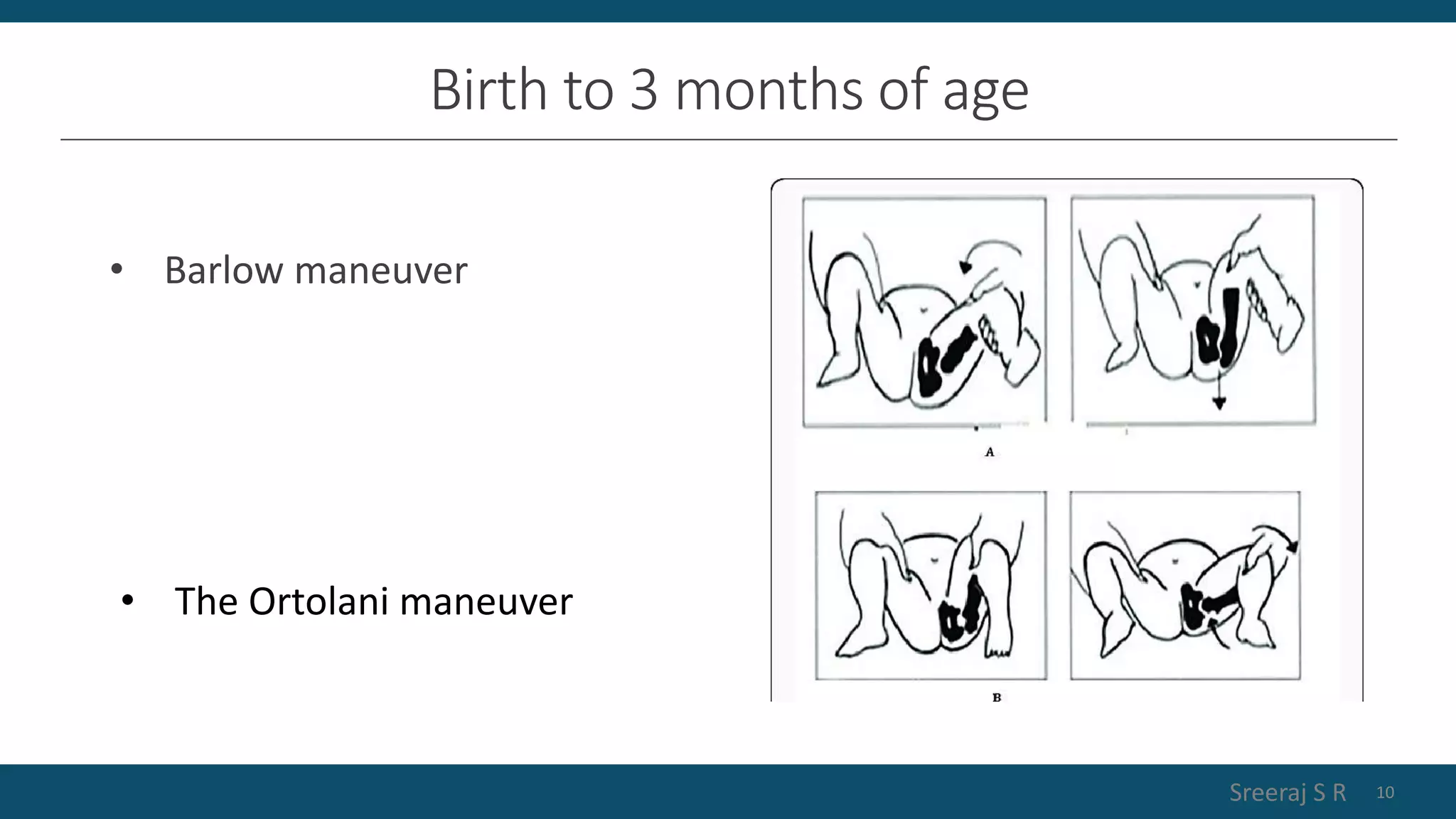 physiotherapy-in-developmental-dysplasia-of-hip-pptx