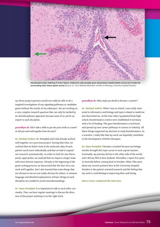 my three project partners would not really be able to do a
targeted investigation of any signaling pathways or candidate
genes without the results of my subproject. We are working on
a very complex research question that can only be tackled by
an interdisciplinary approach, because none of us can be an
expert in each discipline.
gesundhyte.de: Did it take a while to get into your stride as a team?
Or did you work well together from the start?
Dr. Michael Seifert: Dr. Westphal and I had already worked
well together on a previous project. During that time, we
realized that we had to look at the molecular data of each
patient much more individually and that we had to expand
our research systematically. In order to look for new thera-
peutic approaches, we realized that we require a larger team
with more diverse expertise. Already in the beginning of the
grant writing process, we discovered that the four of us can
work well together. But I also learned that some things that
are obvious to me are not really obvious for others. A common
language and detailed explanations of basic things in each
discipline are needed to avoid misunderstandings.
Dr. Dana Westphal: It is important to talk to each other con-
stantly. Thus, we have regular meetings to discuss the direc-
tion of the project and keep it on the right track.
gesundhyte.de: What made you decide to become a scientist?
Dr. Michael Seifert: When I was in school, I was really inter-
ested in informatics and biology and topics related to medicine
also fascinated me. At the time when I graduated from high
school, bioinformatics centers were established in Germany
with a lot of funding. This gave bioinformatics a real boost
and opened up new career pathways in science or industry. All
these things supported my decision to study bioinformatics. As
a scientist, I really like that my work can hopefully contribute
to the development of better therapies.
Dr. Dana Westphal: I became a scientist because my biology
teacher brought this topic across in such a great manner.
Eventually, my journey led me to the other side of the world,
and I did my PhD in New Zealand. Thereafter, I spent five years
in Australia before coming back to Dresden. What I like most
about my current position here at the University Hospital
Dresden is the patient-oriented research and the feeling that
my work is contributing to improving their well-being.
Marco Leuer conducted the interview.
75
www.gesundhyte.de Interview Dana Westphal and Michael Seifert
Hematoxylin-eosin staining of tumor tissue: melanoma cells (purple) grow along blood vessels (black arrow) and invade the
surrounding brain tissue (green arrow) (Source: Dr. med. Matthias Meinhardt, Institute of Pathology, University Hospital Dresden).
 