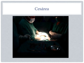 Cesárea
 