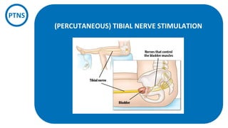 Taalvaardigheid
in de zorg
PTNS
(PERCUTANEOUS) TIBIAL NERVE STIMULATION
 