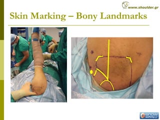Skin Marking – Bony Landmarks
www.shoulder.gr
 