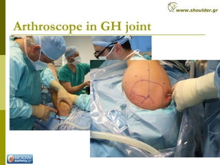 Arthroscope in GH joint
www.shoulder.gr
 