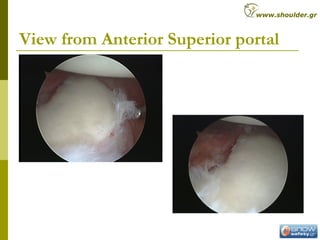 View from Anterior Superior portal
www.shoulder.gr
 