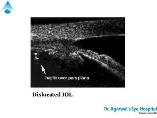 Slight Dislocation Iol Ptosis | PPT
