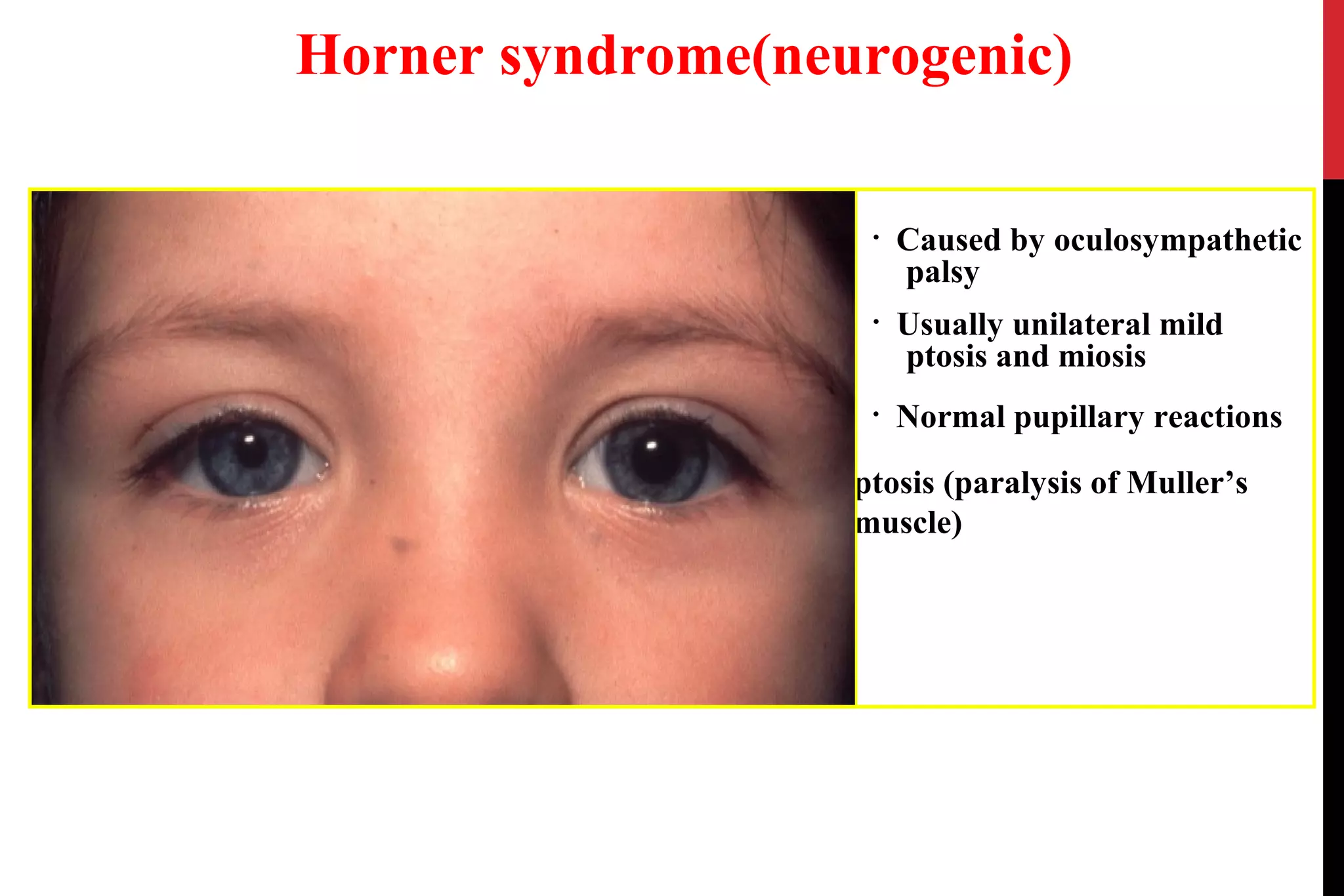 Ptosis | PPT