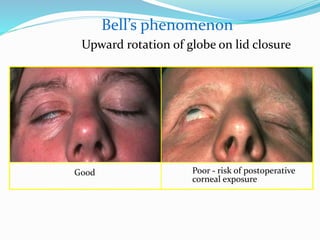 Bell's Reflex Ptosis | PPTX