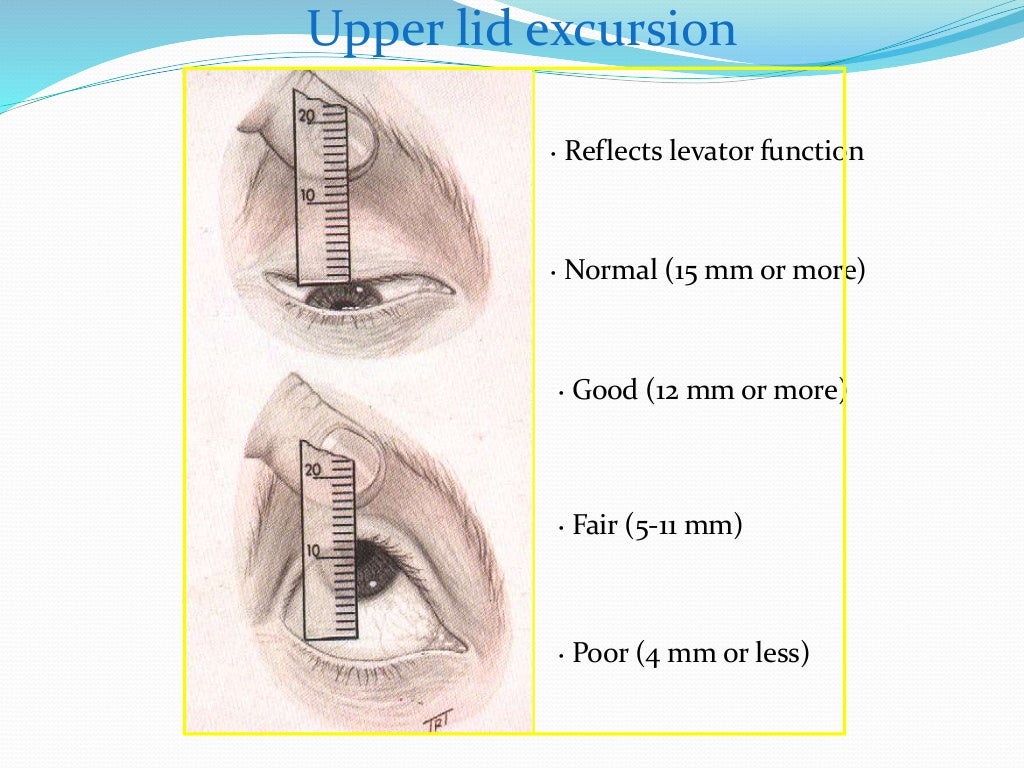 ptosis