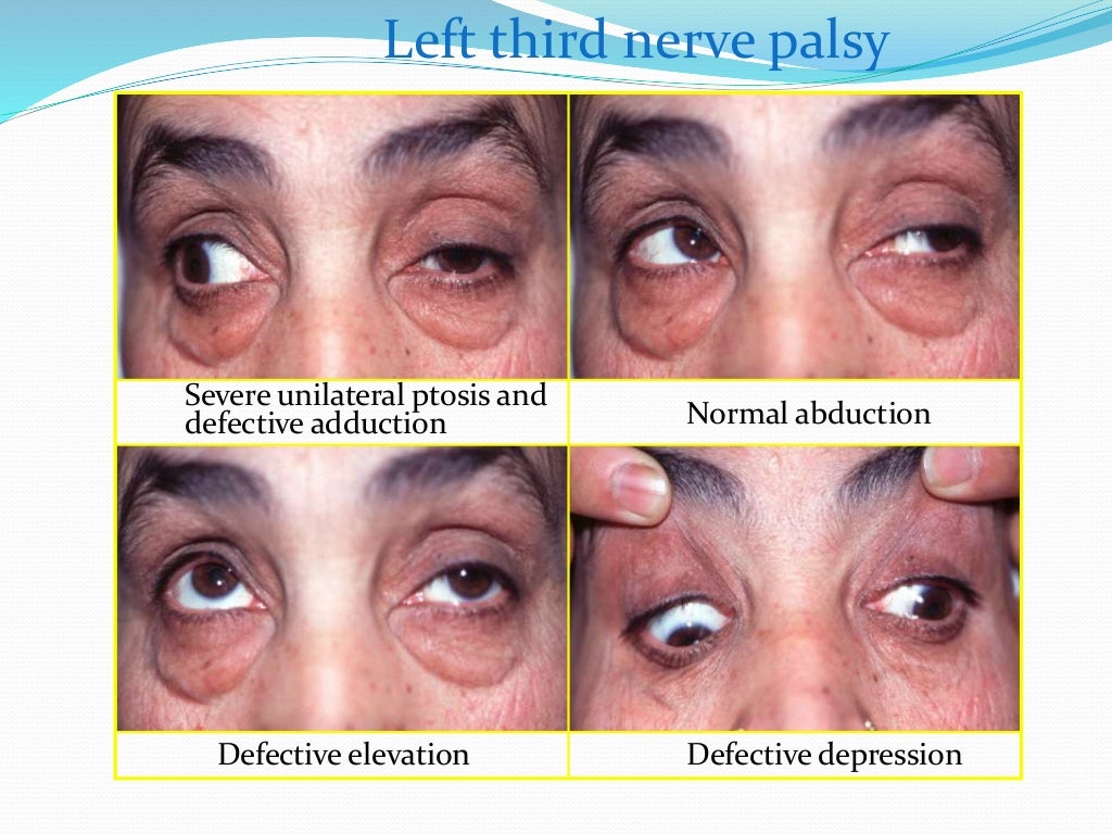 Ptosis