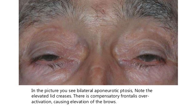 ptosis