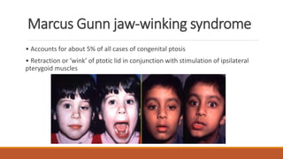 Marcus Gunn jaw-winking syndrome
• Accounts for about 5% of all cases of congenital ptosis
• Retraction or ‘wink’ of ptotic lid in conjunction with stimulation of ipsilateral
pterygoid muscles
 