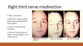 Right third nerve misdirection
• Rare, unilateral
• Aberrant regeneration
following acquired third
nerve palsy
• Pupil is occasionally
involved
• Bizarre movements of
upper lid accompany eye
movements
 