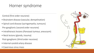 Horner syndrome
Central (first order neurone)
• Brainstem disease (vascular, demyelination)
• Spinal cord disease (syringomyelia, tumours)
Pre-ganglionic (second order neurone)
• Intrathoracic lesions (Pancoast tumour, aneurysm)
• Neck lesions (glands, trauma)
Post-ganglionic (third order neurone)
• Internal carotid artery disease
• Cavernous sinus mass
 