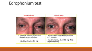 Edrophonium test
 